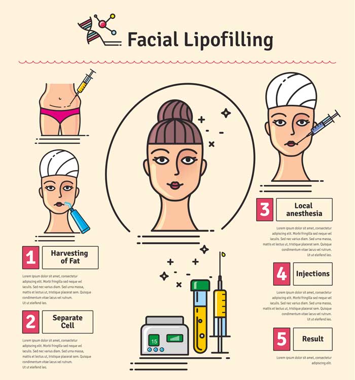 Infografik zur faltenunterspritzung mit Eigenfett